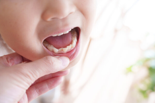 矯正を検討したほうがよい子どもの歯並びイメージ