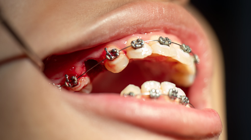 抜歯後にワイヤー矯正を施術したイメージ