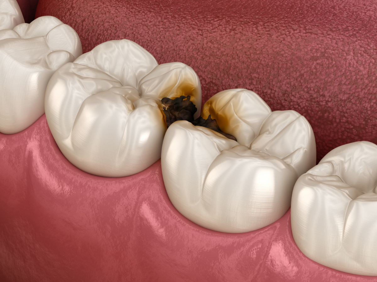 すきっ歯を放置すると発生する虫歯