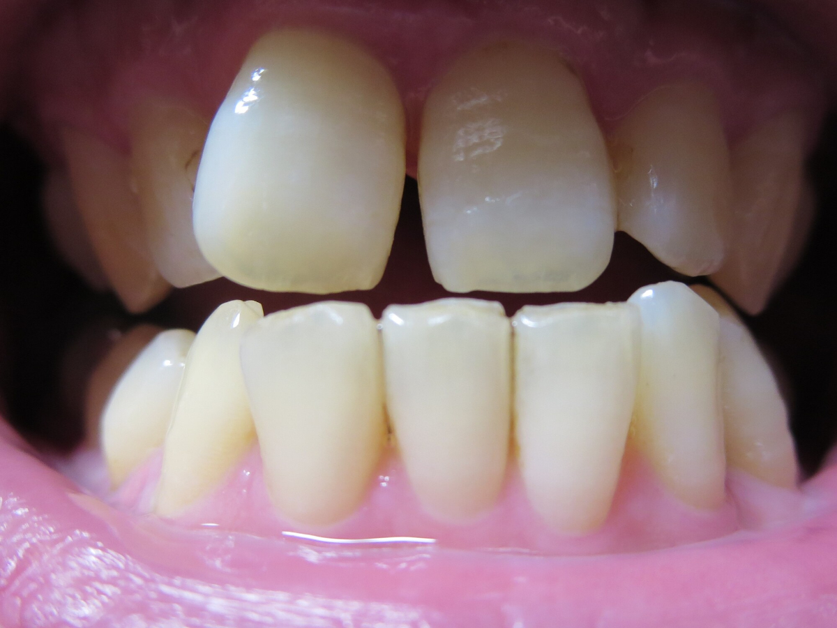 すきっ歯のイメージ