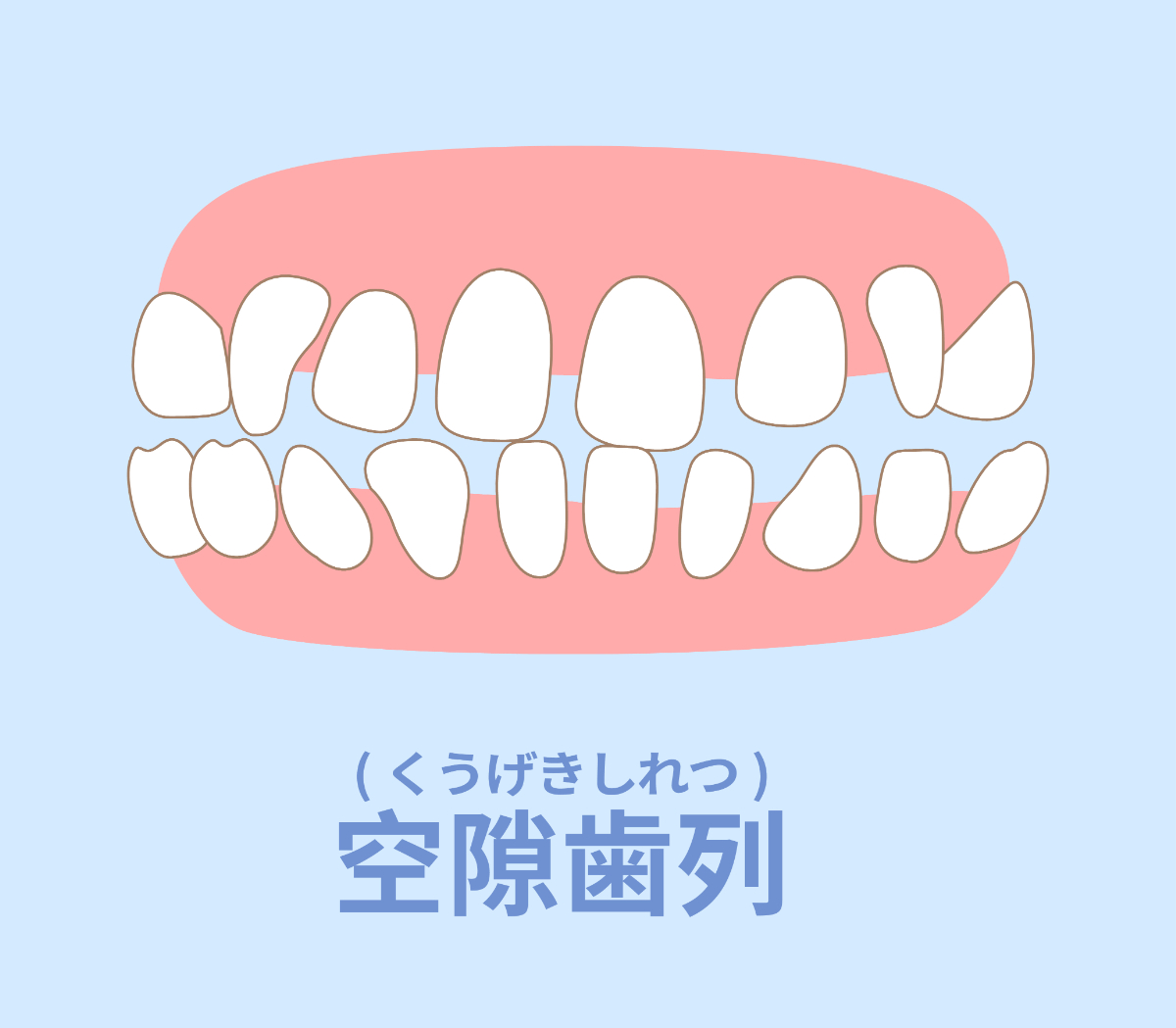 すきっ歯のイメージ